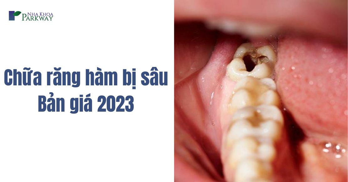 Chữa sâu răng hàm giá bao nhiêu tiền? Bản giá 2023