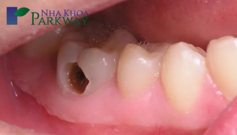 Những triệu chứng sâu răng ở trẻ em