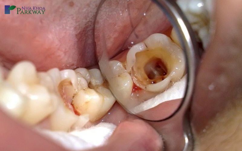 Những điều gì làm tăng khả năng bị sâu răng?