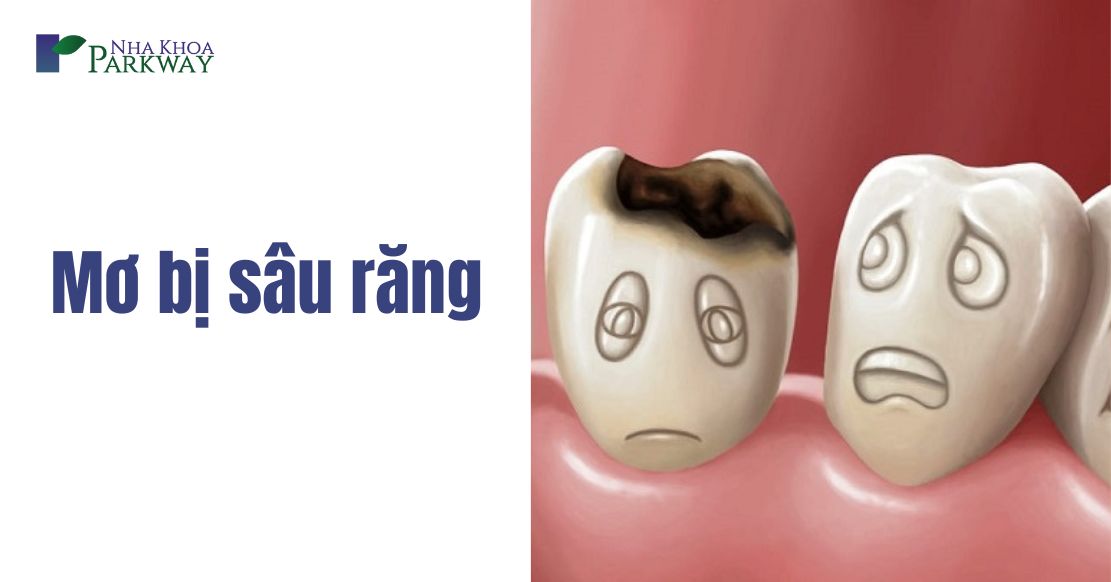 Giải mã nằm mơ bị sâu răng rụng vỡ là điềm gì?