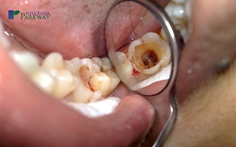 Răng cấm bị sâu nguyên nhân do đâu?