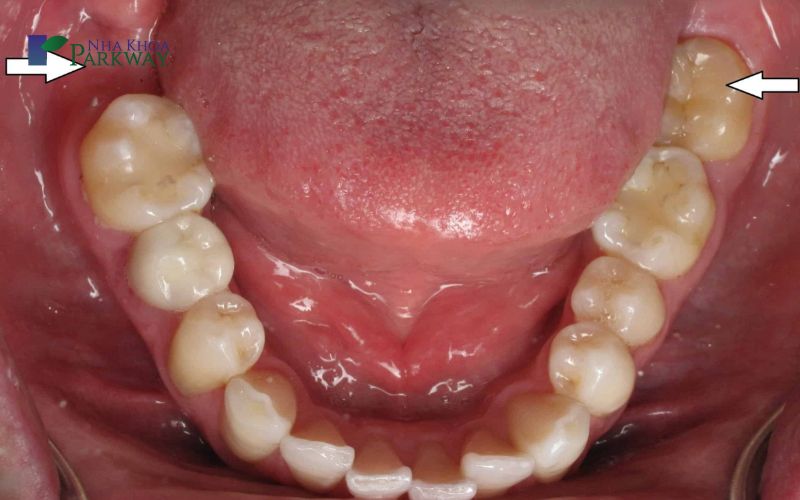 Những nguy hiểm có thể gặp khi nhổ răng cấm bị sâu
