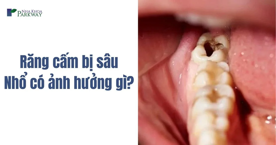 Giải đáp: Nhổ răng cấm bị sâu có ảnh hưởng gì không?