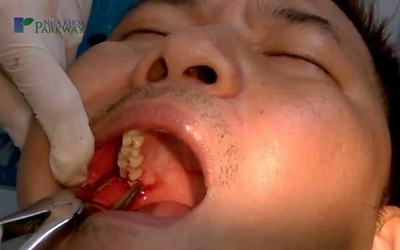 Khi nào cần nhổ răng hàm trên trong cùng bị sâu?