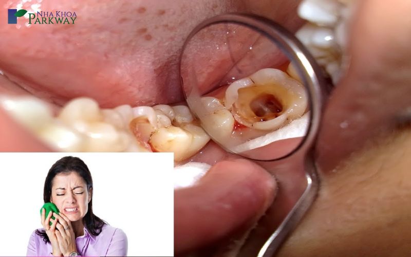 Răng bị sâu để lâu có sao không? Phương pháp điều trị hiệu quả