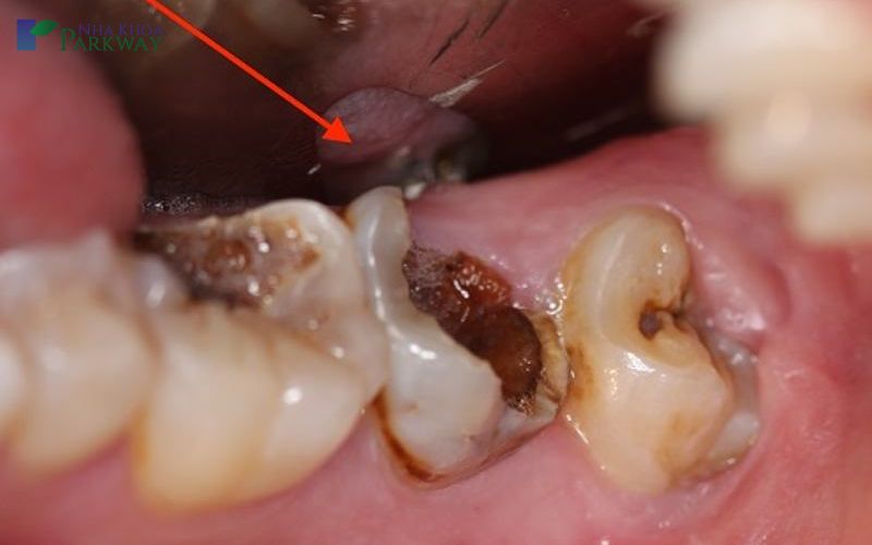 Làm sao để biết có bị sâu răng không?