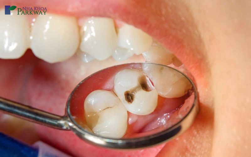 Răng bị sâu để lâu có sao không?