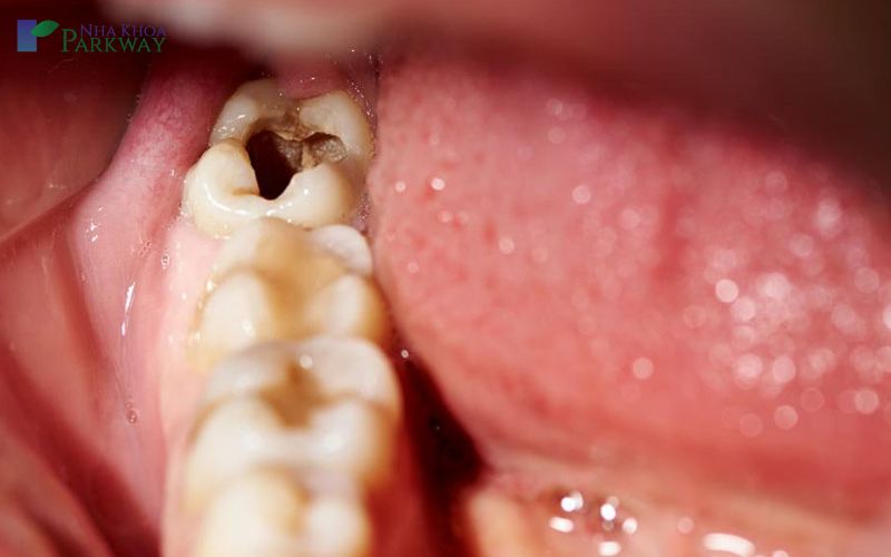Răng bị sâu để lâu có sao không?