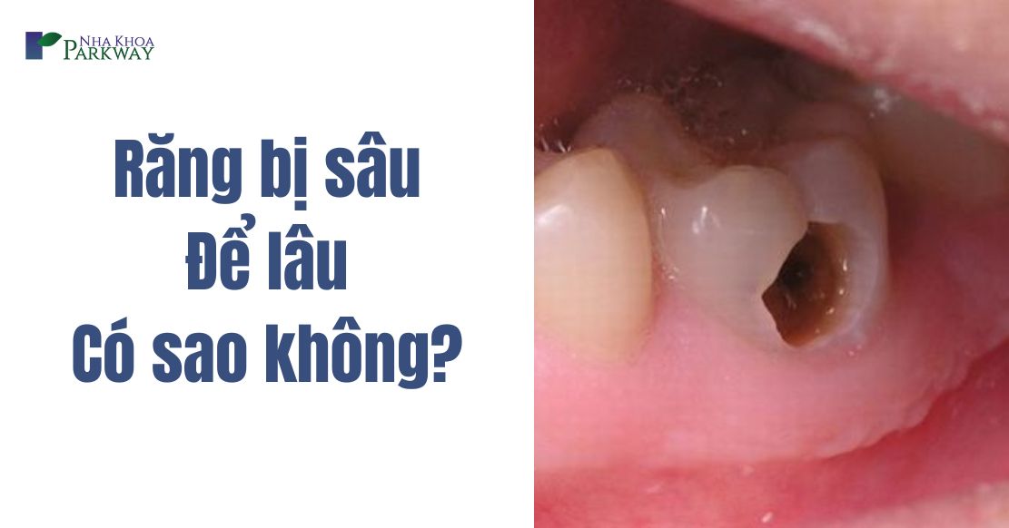 Răng bị sâu để lâu có sao không? Phương pháp điều trị hiệu quả