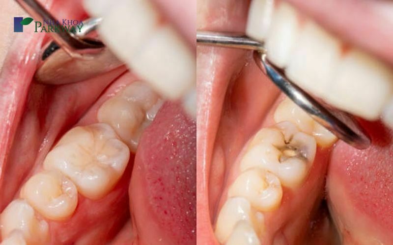 8+ Nguyên nhân răng cấm bị sâu và cách điều trị 