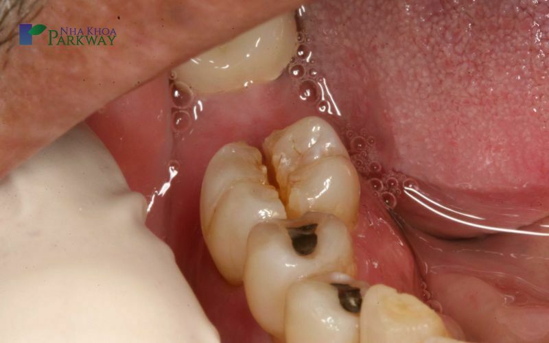 Nguyên nhân răng cấm bị sâu
