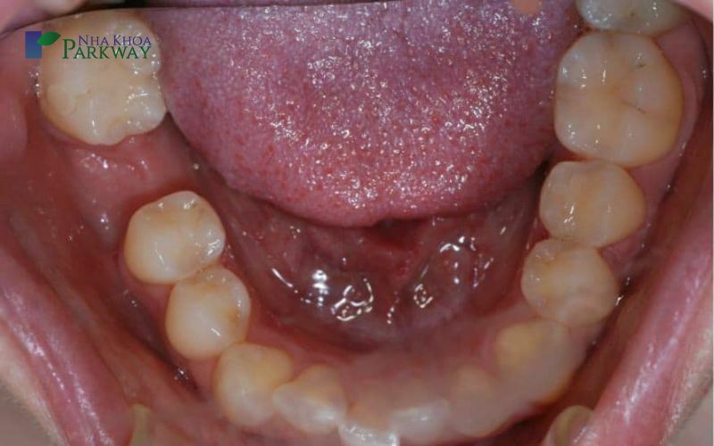 Nên nhổ hay giữ lại răng cấm bị sâu?