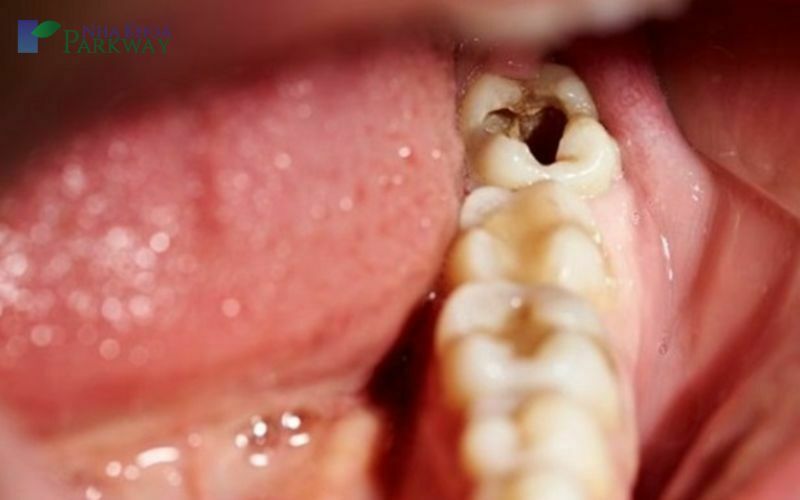 Răng khôn bị sâu vỡ có nguy hiểm không?