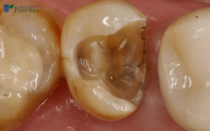 Biểu hiện của tình trạng răng sâu bị vỡ là gì?