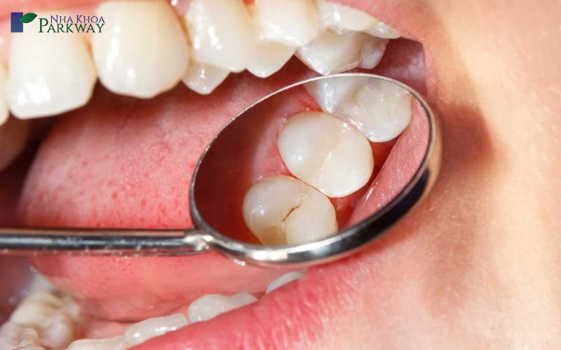 Sâu răng không điều trị kịp thời dẫn đến tác hại gì?