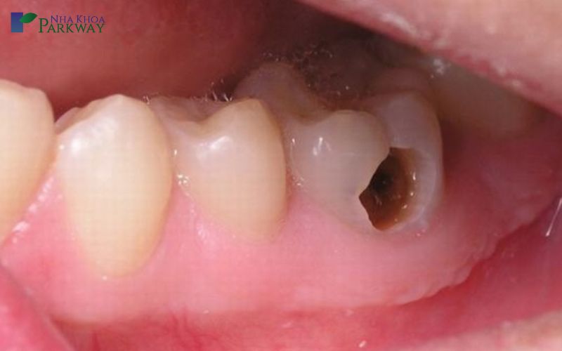 Tìm hiểu răng sâu bị vỡ có trám được không?