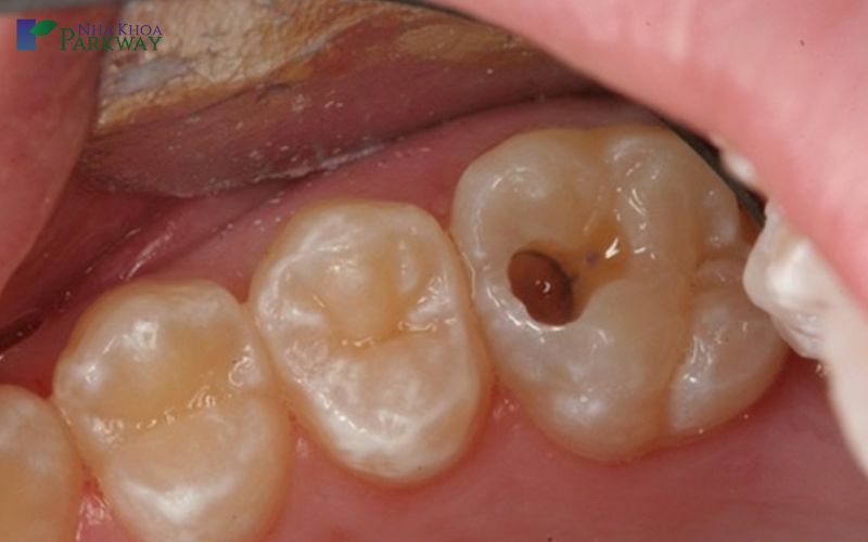 Một số phương pháp điều trị răng sâu bị vỡ khác khách hàng nên tham khảo