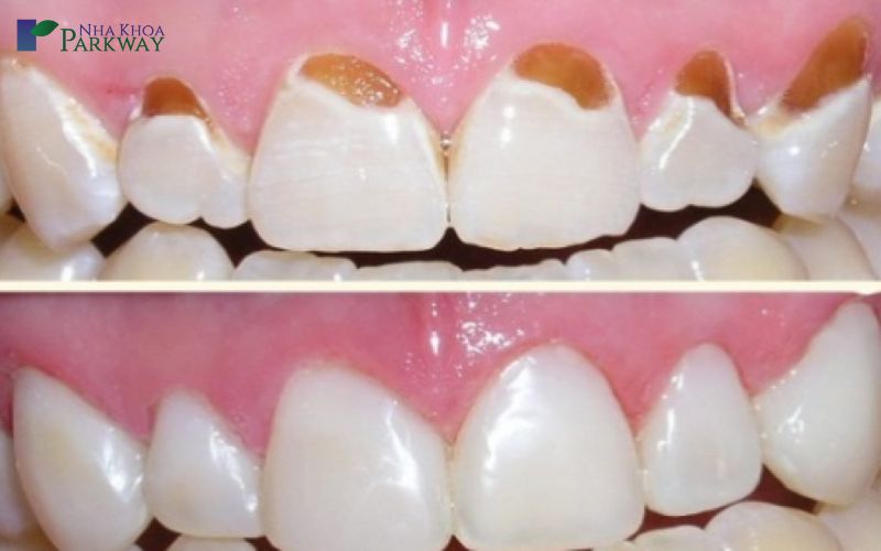 Cách phòng tránh để hạn chế răng sâu bị vỡ