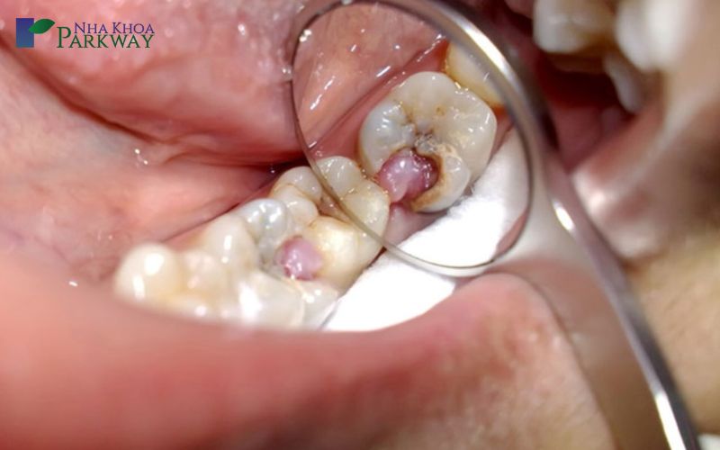 Cách điều trị răng sâu lồi thịt tại nha khoa hiệu quả nhất 