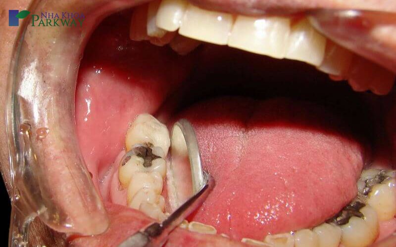 Sâu răng lồi thịt có ảnh hưởng gì?