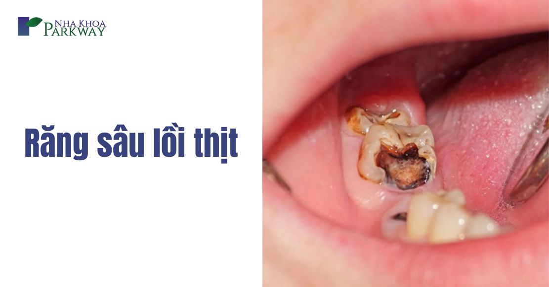 Cách điều trị răng sâu lồi thịt tại nha khoa hiệu quả nhất 