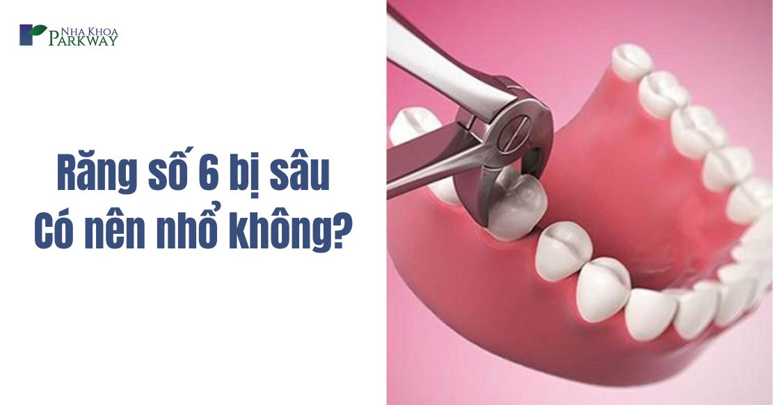 Răng số 6 bị sâu có nên nhổ không? Có nguy hiểm không?