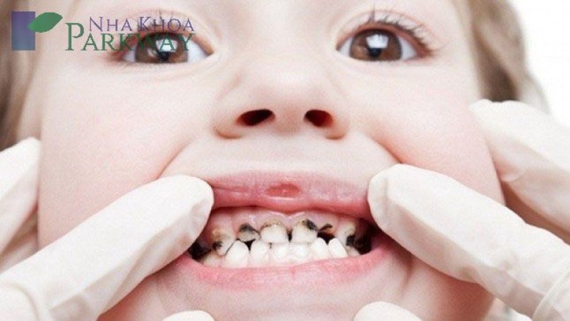 Trẻ mất răng sữa sớm là gì?