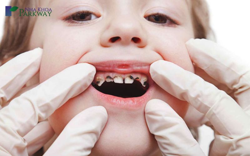 Các bệnh lý thường răng ở chân răng