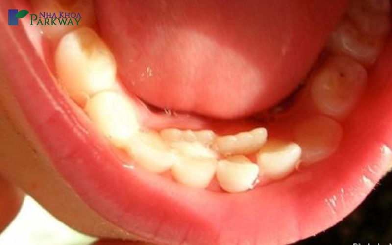 Răng sữa và răng vĩnh viễn có mỗi liên kết như thế nào?