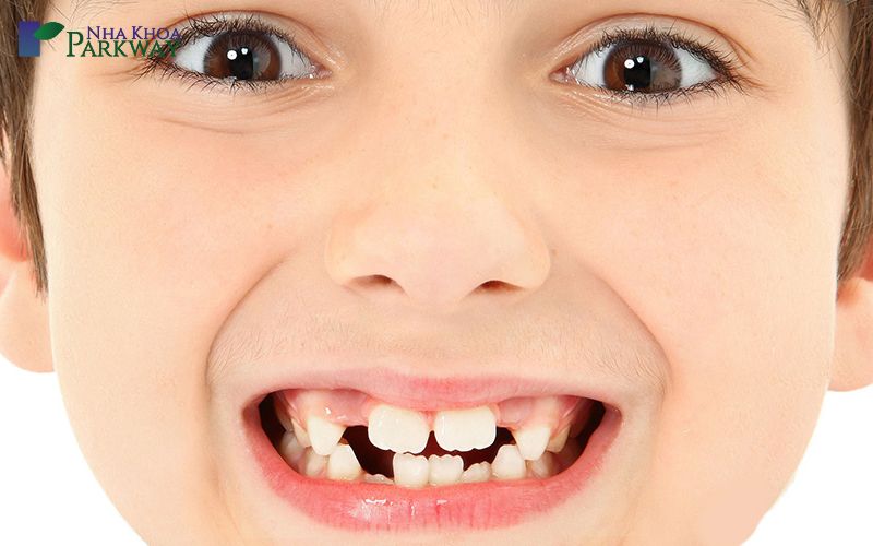 Dấu hiệu và nguyên nhân răng sữa mọc lệch
