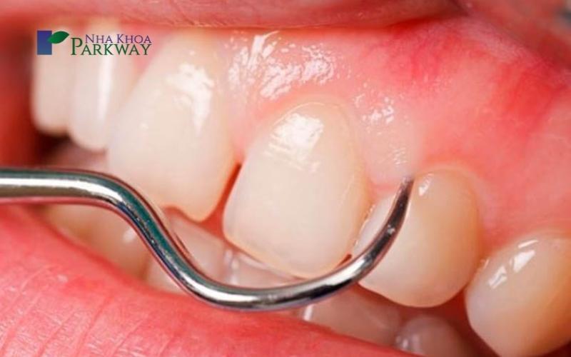 Những nguy hiểm thường gặp ở răng tiền hàm