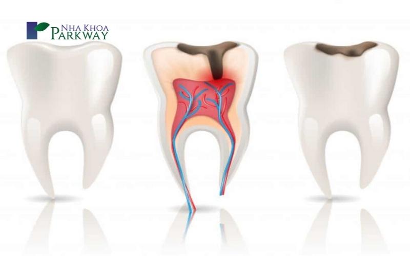 Những nguy hiểm thường gặp ở răng tiền hàm