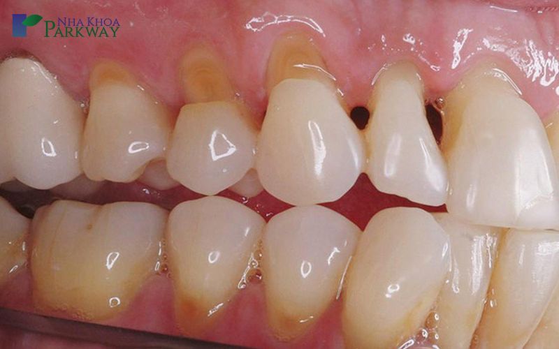 Dấu hiệu và Cách điều trị sâu kẽ răng hiệu quả