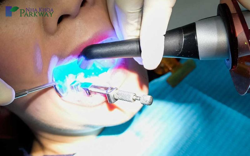  Cách bước thực hiệu trám răng bị sâu kẽ răng tại nha khoa