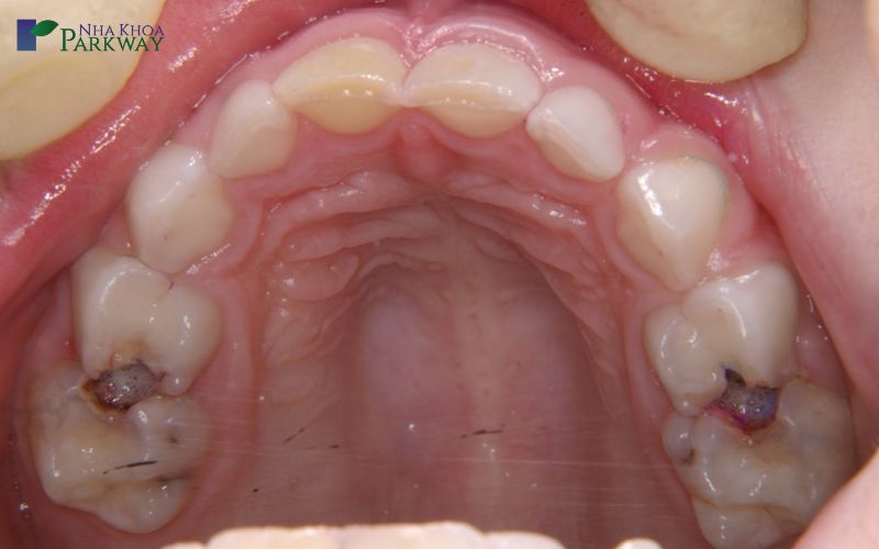 Dấu hiệu nhận biết sâu răng