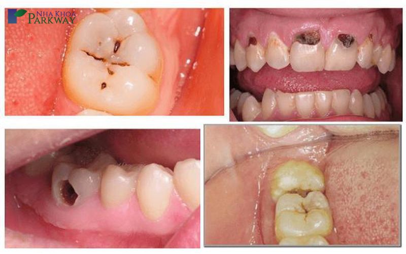 Nguyên nhân sâu răng là gì?