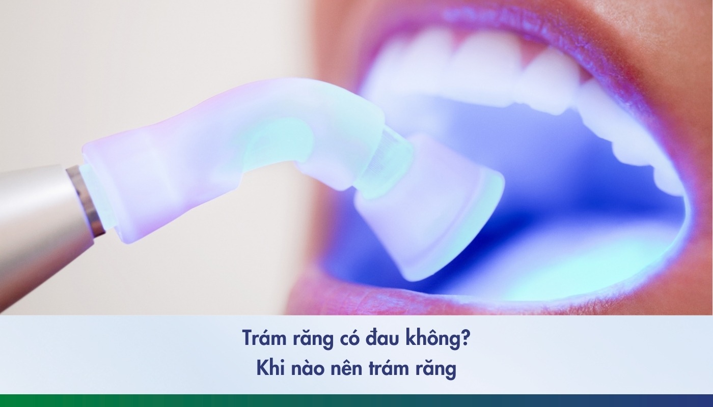 Trám răng có đau không? Trường hợp nào nên trám răng