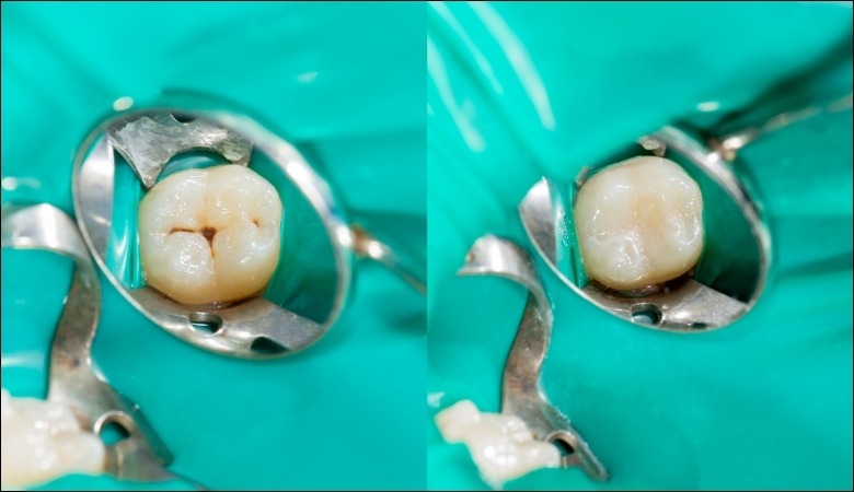 Trám răng giúp phục hồi răng bị sứt mẻ, sâu