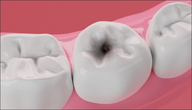 Trám răng khi bị sâu 