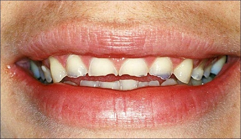 Trám răng khi bị mài mòn