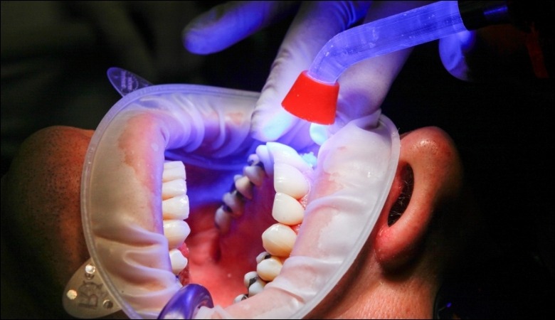 Công nghệ trám răng không đau laser tech