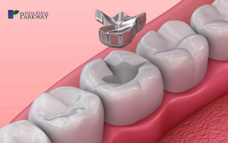 Cách hạn chế tình trạng răng trám rồi bị sâu lại như thế nào?