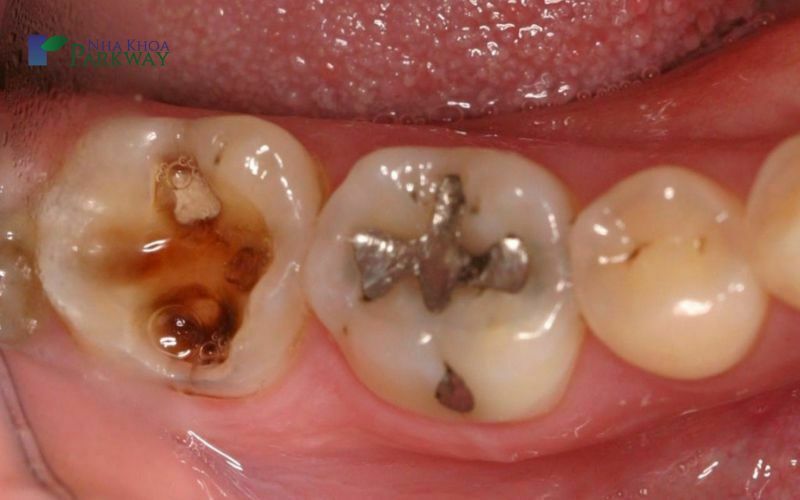 Trám răng sâu có đau không? Những lợi ích của trám răng sâu