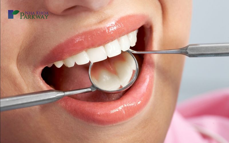 Vì sao nên trám răng khi sâu răng