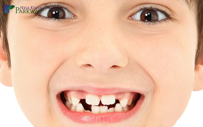 Số răng sữa của trẻ em là bao nhiêu?