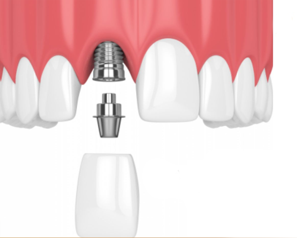 Hình ảnh gắn răng cửa sứ giả vào abutment sau khi đã trồng trụ implant