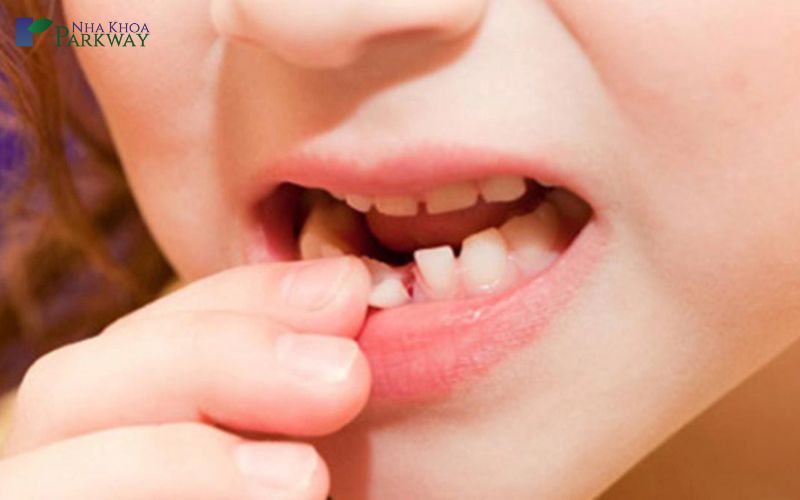 Dấu hiệu thay răng sữa của bé và có nên tự nhổ ở nhà?