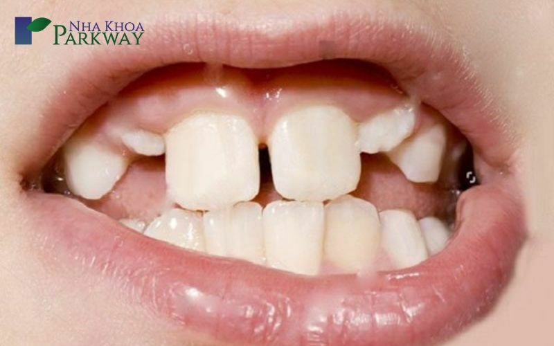 Nguyên nhân dẫn đến răng cửa bị hở thưa là gì?