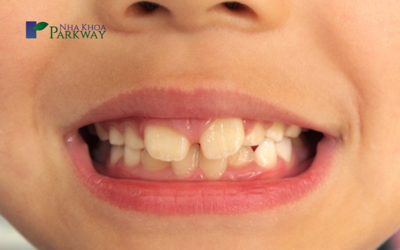 Dấu hiệu nhận biết răng sữa bị mòn ở trẻ em