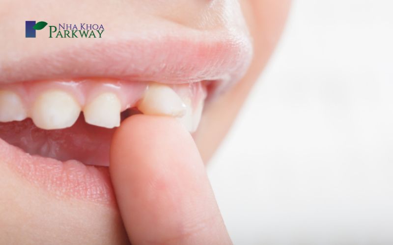Nhổ răng sữa khi trẻ đến tuổi thay răng